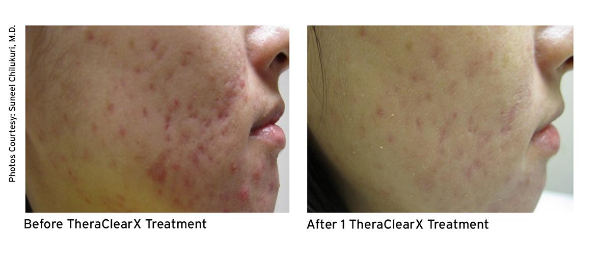 Warts: Pictures, Causes, Types, Removal, and Treatment - WebMD